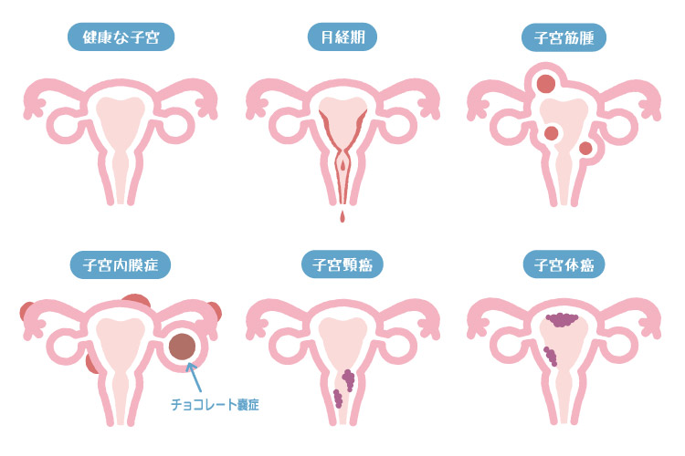 婦人科疾患のイメージ画像